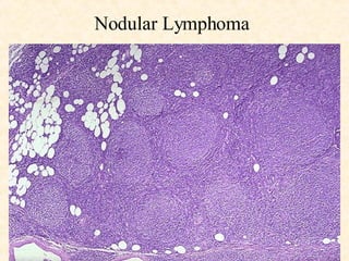 Nodular Lymphoma 