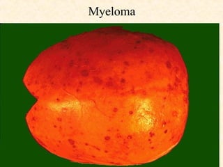 Myeloma 