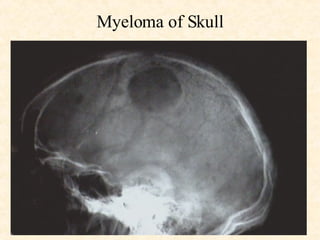 Myeloma of Skull 