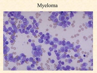 Myeloma 