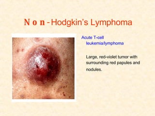 Non- Hodgkin’s Lymphoma   Acute T-cell leukemia/lymphoma  Large, red-violet tumor with surrounding red papules and nodules. 