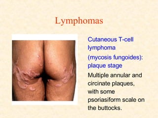 Lymphomas Cutaneous T-cell lymphoma (mycosis fungoides): plaque stage  Multiple annular and circinate plaques, with some psoriasiform scale on the buttocks. 