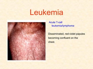 Leukemia Acute T-cell leukemia/lymphoma  Disseminated, red-violet papules becoming confluent on the chest. 