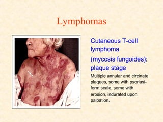 Lymphomas Cutaneous T-cell lymphoma (mycosis fungoides): plaque stage Multiple annular and circinate plaques, some with psoriasi-form scale, some with erosion, indurated upon palpation. 