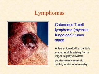 Lymphomas Cutaneous T-cell lymphoma (mycosis fungoides): tumor stage  A fleshy, tomato-like, partially eroded nodule arising from a larger, slightly elevated, psoriasiform plaque with scaling and central atrophy. 