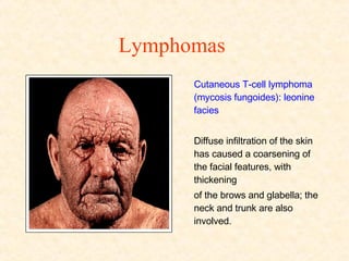 Lymphomas   Cutaneous T-cell lymphoma (mycosis fungoides): leonine facies  Diffuse infiltration of the skin has caused a coarsening of the facial features, with thickening of the brows and glabella; the neck and trunk are also involved. 