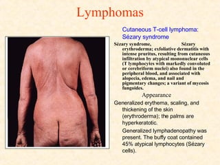 Lymphomas Cutaneous T-cell lymphoma: Sézary syndrome  Sézary syndrome,  Sézary  erythroderma; exfoliative dermatitis with intense pruritus, resulting from cutaneous infiltration by atypical mononuclear cells (T lymphocytes with markedly convoluted or cerebriform nuclei) also found in the peripheral blood, and associated with alopecia, edema, and nail and  pigmentary changes; a variant of mycosis fungoides.   Appearance Generalized erythema, scaling, and thickening of the skin (erythroderma); the palms are hyperkeratotic. Generalized lymphadenopathy was present. The buffy coat contained 45% atypical lymphocytes (Sézary cells). 