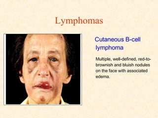 Lymphomas Cutaneous B-cell lymphoma  Multiple, well-defined, red-to-brownish and bluish nodules on the face with associated edema. 