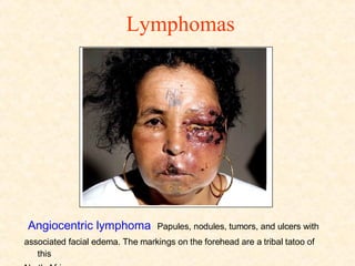 Lymphomas Angiocentric lymphoma   Papules, nodules, tumors, and ulcers with associated facial edema. The markings on the forehead are a tribal tatoo of this North African woman. 