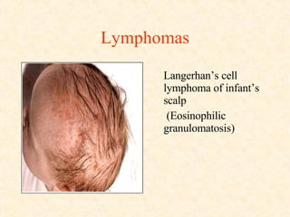 Lymphomas Langerhan’s cell lymphoma of infant’s scalp  (Eosinophilic  granulomatosis) 