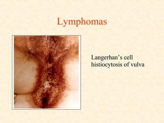 Lymphomas Langerhan’s cell histiocytosis of vulva 