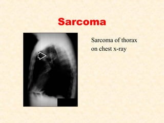 Sarcoma Sarcoma of thorax on chest x-ray 