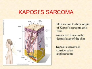 KAPOSI’S SARCOMA Skin section to show origin of Kaposi’s sarcoma cells from  connective tissue in the dermis layer of the skin Kaposi’s sarcoma is considered an angiosarcoma 