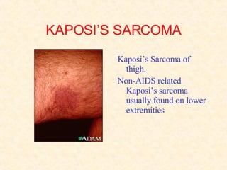 KAPOSI’S SARCOMA Kaposi’s Sarcoma of thigh.  Non-AIDS related Kaposi’s sarcoma usually found on lower extremities  
