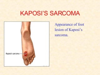 KAPOSI’S SARCOMA Appearance of foot lesion of Kaposi’s  sarcoma. 