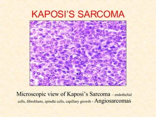 KAPOSI’S SARCOMA Microscopic view of Kaposi’s Sarcoma  – endothelial cells, fibroblasts, spindle cells, capillary growth -  Angiosarcomas   