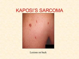 KAPOSI’S SARCOMA Lesions on back 