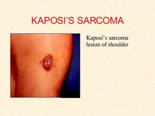 KAPOSI’S SARCOMA Kaposi’s sarcoma lesion of shoulder 