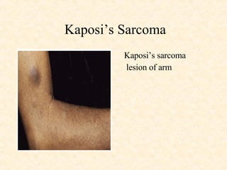 Kaposi’s Sarcoma Kaposi’s sarcoma  lesion of arm 