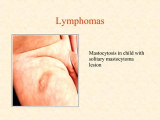 Lymphomas Mastocytosis in child with solitary mastocytoma lesion 
