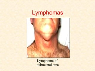 Lymphomas Lymphoma of submental area 