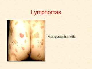 Lymphomas   Mastocytosis in a child 