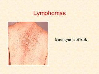 Lymphomas Mastocytosis of back  