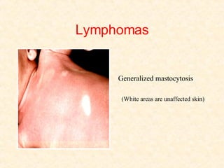 Lymphomas Generalized mastocytosis (White areas are unaffected skin) 