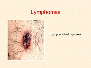 Lymphomas Lymphomatoid papulosis 