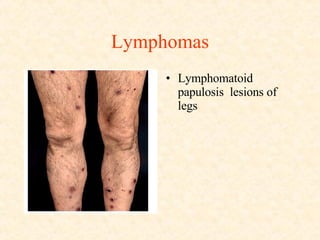 Lymphomas Lymphomatoid papulosis  lesions of legs  