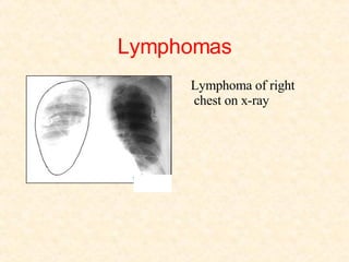 Lymphomas Lymphoma of right chest on x-ray 