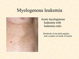 Myelogenous leukemia Acute myelogenous leukemia with leukemia cutis Hundreds of tan-pink papules and a nodule on trunk of female 