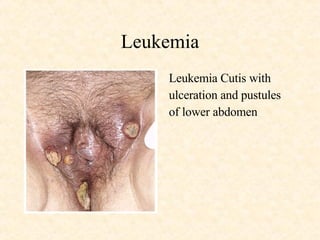 Leukemia Leukemia Cutis with  ulceration and pustules  of lower abdomen 