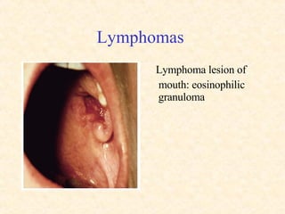 Lymphomas  Lymphoma lesion of mouth: eosinophilic granuloma 