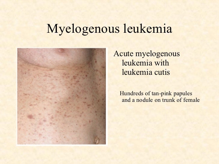 Malignant Diseases Lymphatics & Soft Tissue #3