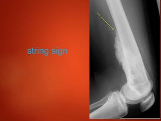 String. Sign Radiology Brain Malignant bone Tumors,Radiology | PPTX