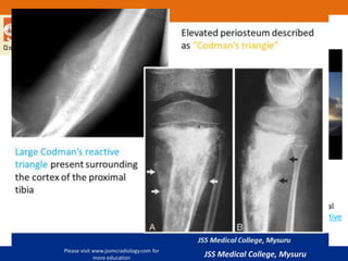 Imaging in malignant bone tumors | PPTX
