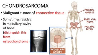 CHONDROSARCOMA
•Malignant tumor of connective tissue
• Sometimes resides
in medullary cavity
of bone
(distinguish this
from
osteochondroma)
 