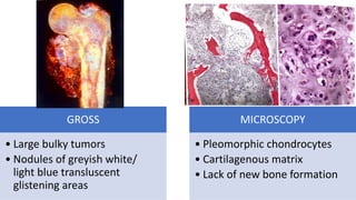 GROSS
• Large bulky tumors
• Nodules of greyish white/
light blue transluscent
glistening areas
MICROSCOPY
• Pleomorphic chondrocytes
• Cartilagenous matrix
• Lack of new bone formation
 