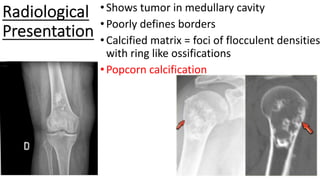 Radiological
Presentation
•Shows tumor in medullary cavity
•Poorly defines borders
•Calcified matrix = foci of flocculent densities
with ring like ossifications
•Popcorn calcification
 