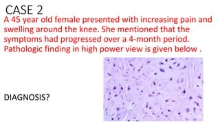 CASE 2
A 45 year old female presented with increasing pain and
swelling around the knee. She mentioned that the
symptoms had progressed over a 4-month period.
Pathologic finding in high power view is given below .
DIAGNOSIS?
 