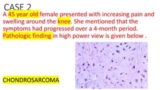 CASE 2
A 45 year old female presented with increasing pain and
swelling around the knee. She mentioned that the
symptoms had progressed over a 4-month period.
Pathologic finding in high power view is given below .
CHONDROSARCOMA
 