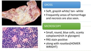 • Soft, grayish white/ tan- white
• Frequently areas of hemorrhage
and necrosis are also seen.
GROSS
• Small, round, blue cells, scanty
cytoplasm(rich in glycogen)
• PAS stain positive
• along with rosettes(HOMER
WRIGHT)
MICROSCOPY
 