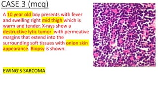 CASE 3 (mcq)
A 10 year old boy presents with fever
and swelling right mid thigh which is
warm and tender. X-rays show a
destructive lytic tumor with permeative
margins that extend into the
surrounding soft tissues with onion skin
appearance. Biopsy is shown.
EWING’S SARCOMA
 
