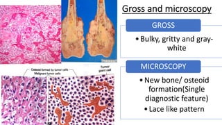 Gross and microscopy
•Bulky, gritty and gray-
white
GROSS
•New bone/ osteoid
formation(Single
diagnostic feature)
•Lace like pattern
MICROSCOPY
 