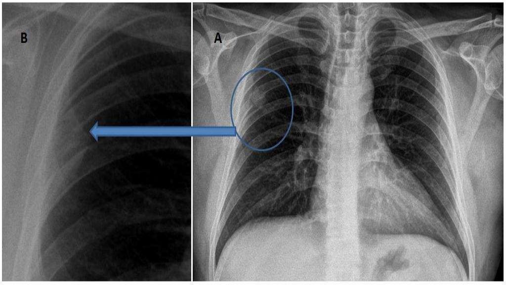 Malignant bone tumors 2