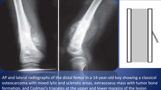 AP and lateral radiographs of the distal femur in a 14-year-old boy showing a classical
osteocarcoma with mixed lytic and sclerotic areas, extraosseus mass with tumor bone
formation, and Codman’s triangles at the upper and lower margins of the lesion
 