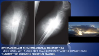 OSTEOSARCOMA OF THE METADIAPHYSEAL REGION OF TIBIA
- MIXED LESION WITH A LARGE SOFT TISSUE COMPONENT AND THE CHARACTERISTIC
“SUNBURST” OR SPICULATED PERIOSTEAL REACTION
 