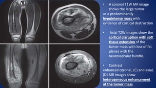 • A coronal T1W MR image
shows the large tumor
as a predominantly
hypointense mass with
evidence of cortical destruction
• Axial T2W images show the
cortical disruption with soft
tissue extension of the
tumor mass with loss of fat
planes with the
neurovascular bundle.
• Contrast
enhanced coronal, (C) and axial,
(D) MR images show
heterogeneous enhancement
of the tumor mass
 