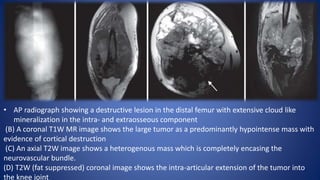 • AP radiograph showing a destructive lesion in the distal femur with extensive cloud like
mineralization in the intra- and extraosseous component
(B) A coronal T1W MR image shows the large tumor as a predominantly hypointense mass with
evidence of cortical destruction
(C) An axial T2W image shows a heterogenous mass which is completely encasing the
neurovascular bundle.
(D) T2W (fat suppressed) coronal image shows the intra-articular extension of the tumor into
the knee joint
 